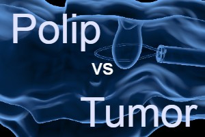 polip és daganat közötti különbség